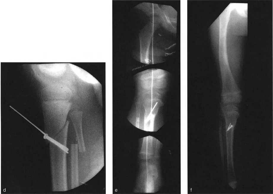 صورة توضيحية لـ تصحيح تشوهات العظام المعقدة: دليل شامل لتقنيات بالي المتقدمة مع الأستاذ الدكتور محمد هطيف