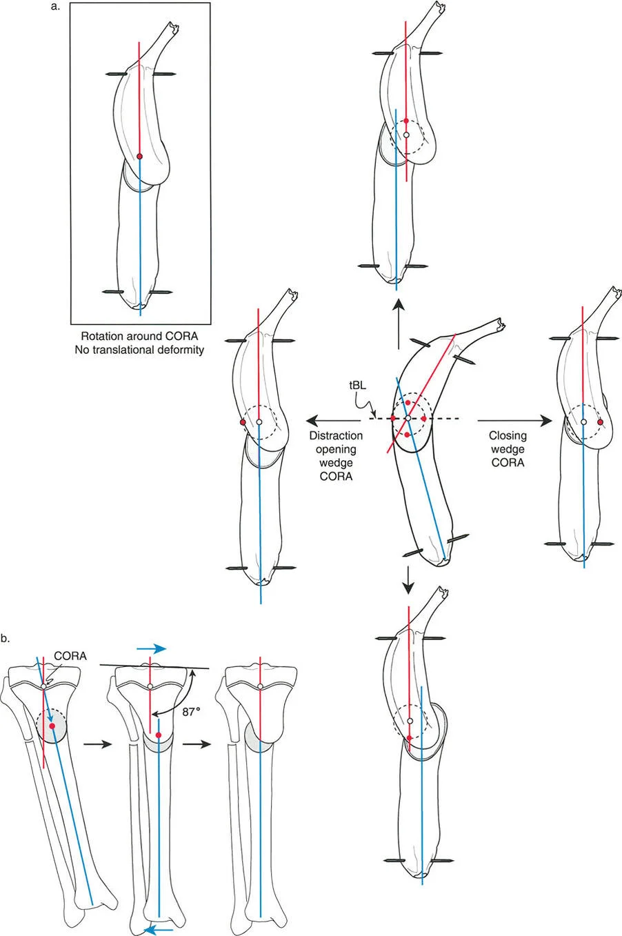 توضيح لمركز دوران الانحراف (CORA) وخط التنصيف العرضي (tBL) في تشوه العظام