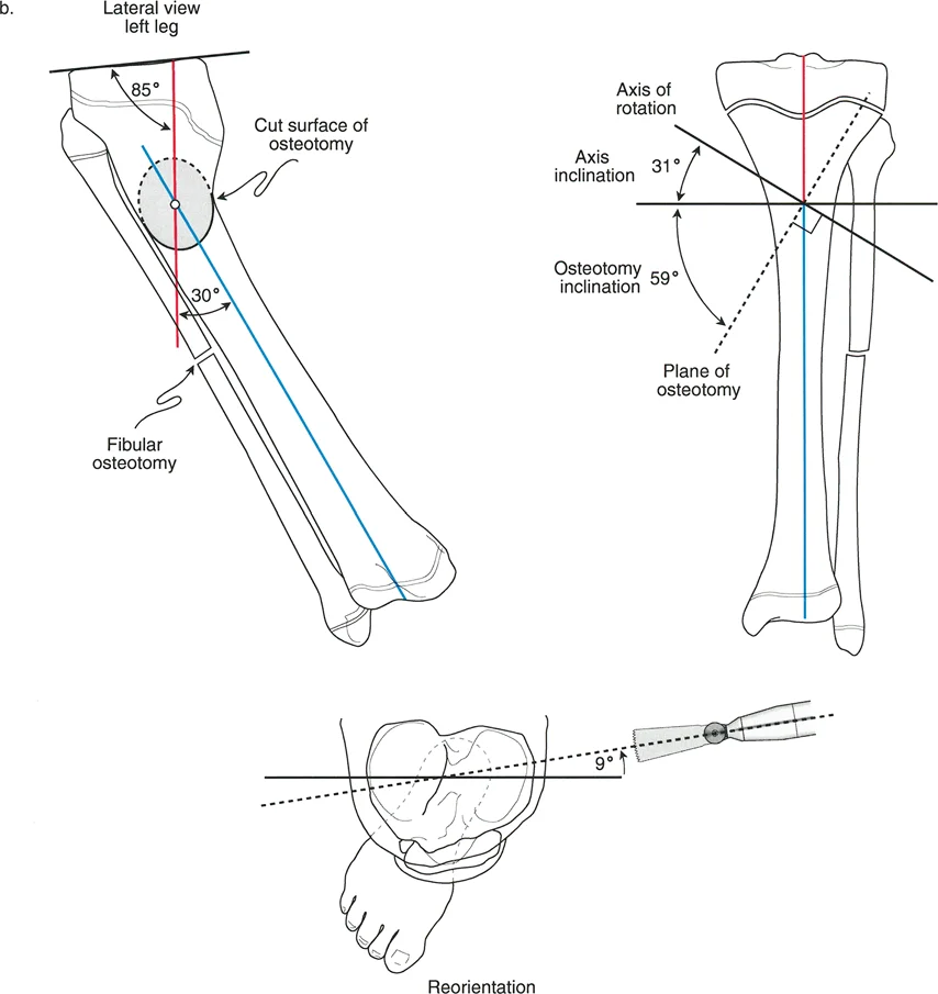 تصحيح تشوهات العظام المعقدة: دليل شامل لتقنيات بالي المتقدمة مع الأستاذ الدكتور محمد هطيف