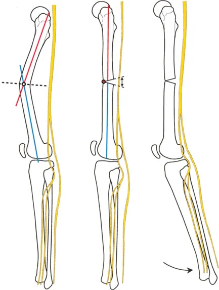 صورة طبية: تصحيح تفاوت طول الساقين وتشوهات الأطراف: مقارنة بين الجراحة الفورية والتدريجية