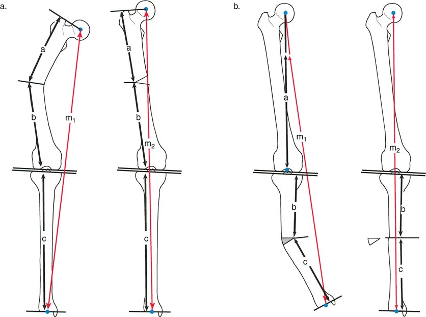صورة توضيحية لـ تصحيح تفاوت طول الساقين وتشوهات الأطراف: مقارنة بين الجراحة الفورية والتدريجية
