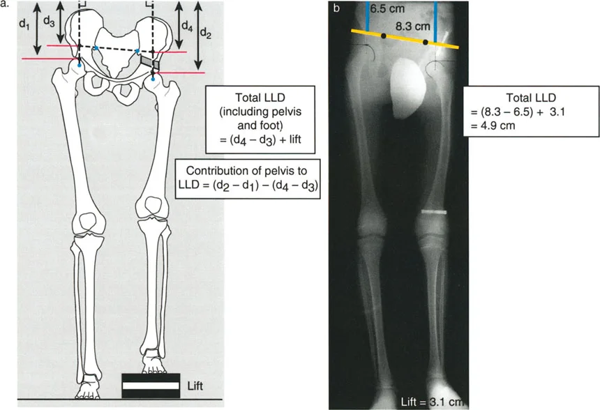 صورة طبية: تصحيح تفاوت طول الساقين وتشوهات الأطراف: مقارنة بين الجراحة الفورية والتدريجية