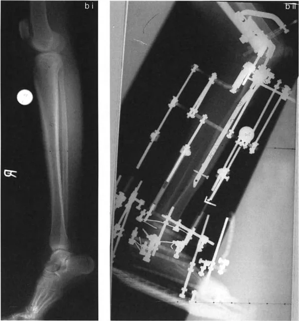 صورة توضيحية لـ تصحيح تفاوت طول الساقين وتشوهات الأطراف: مقارنة بين الجراحة الفورية والتدريجية