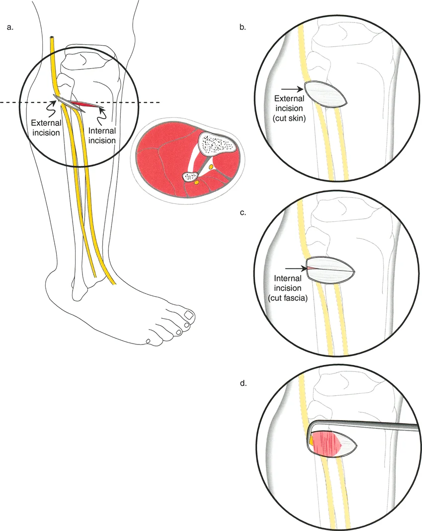 صورة توضيحية لـ تصحيح تفاوت طول الساقين وتشوهات الأطراف: مقارنة بين الجراحة الفورية والتدريجية