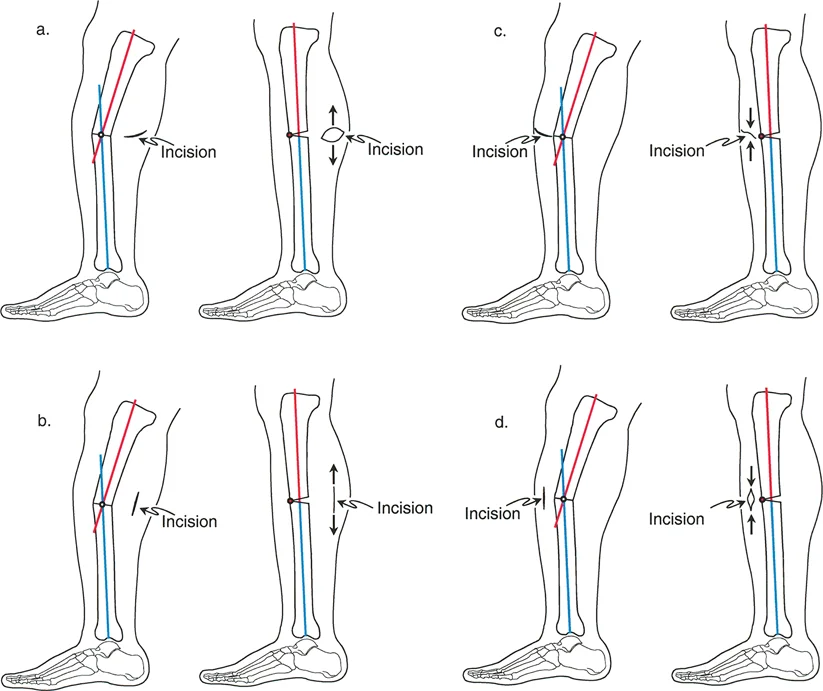 تصحيح تفاوت طول الساقين وتشوهات الأطراف: مقارنة بين الجراحة الفورية والتدريجية
