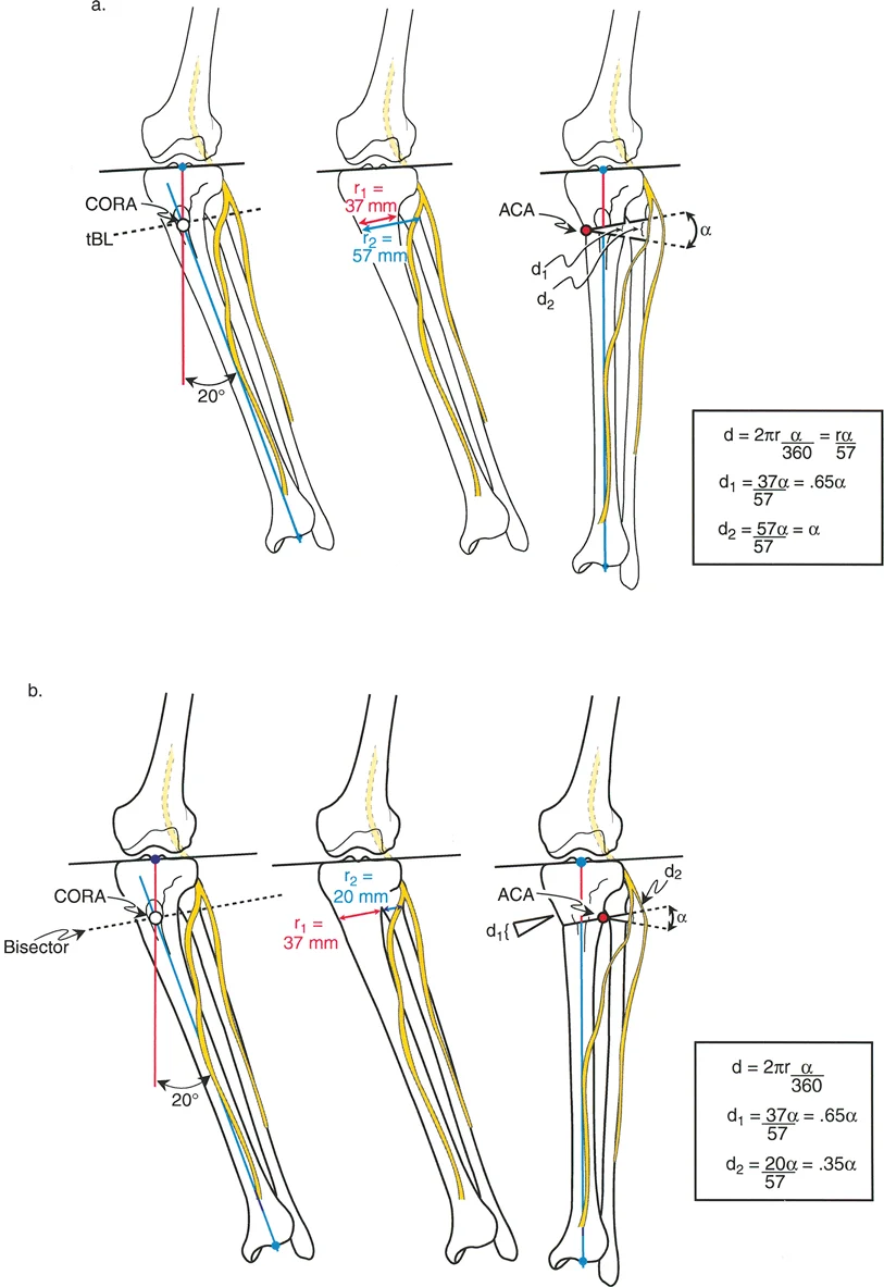 صورة طبية: تصحيح تفاوت طول الساقين وتشوهات الأطراف: مقارنة بين الجراحة الفورية والتدريجية