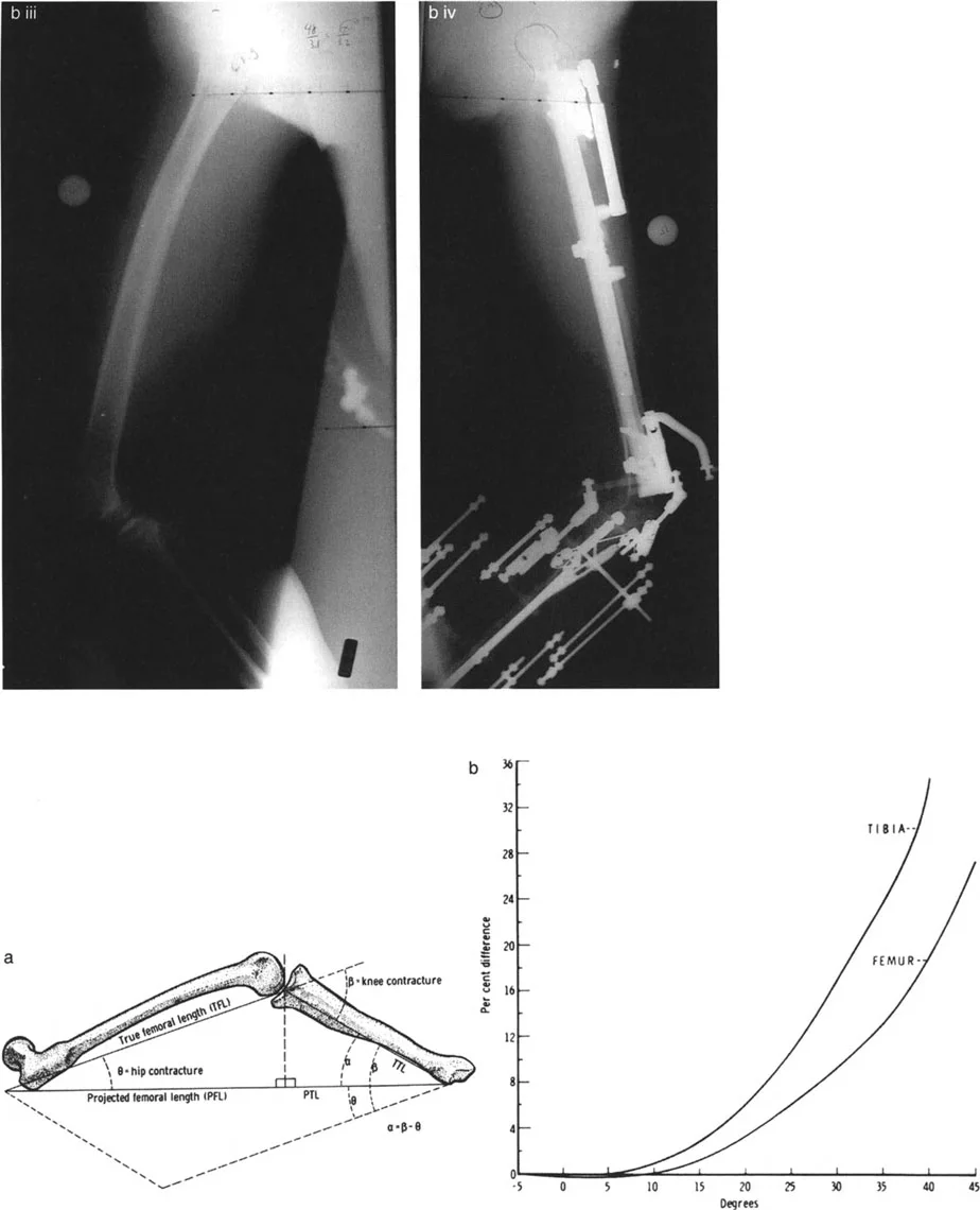 صورة طبية: تصحيح تفاوت طول الساقين وتشوهات الأطراف: مقارنة بين الجراحة الفورية والتدريجية