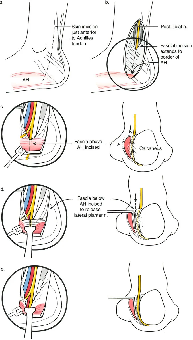 صورة طبية: تصحيح تفاوت طول الساقين وتشوهات الأطراف: مقارنة بين الجراحة الفورية والتدريجية