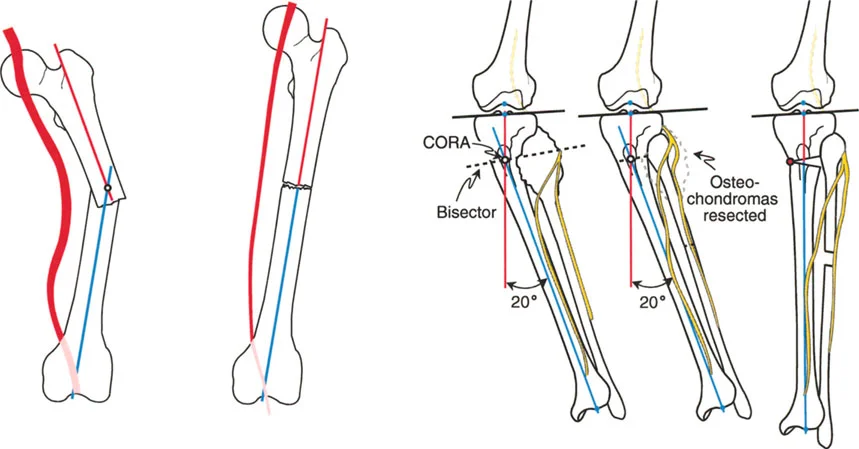 صورة توضيحية لـ تصحيح تفاوت طول الساقين وتشوهات الأطراف: مقارنة بين الجراحة الفورية والتدريجية