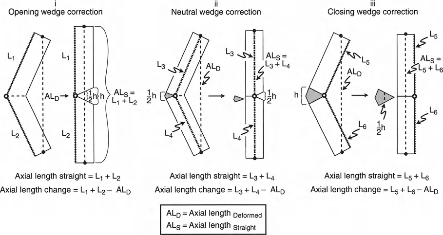 صورة طبية: تصحيح تفاوت طول الساقين وتشوهات الأطراف: مقارنة بين الجراحة الفورية والتدريجية