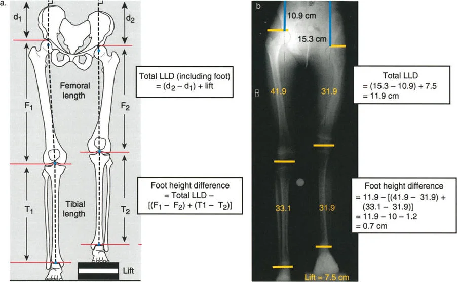 صورة طبية: تصحيح تفاوت طول الساقين وتشوهات الأطراف: مقارنة بين الجراحة الفورية والتدريجية