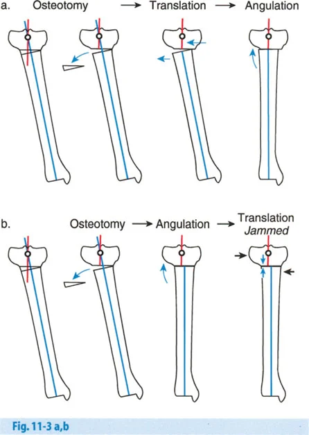 صورة توضيحية لـ تصحيح تشوهات العظام استعادة التوازن والحركة بخبرة الأستاذ الدكتور محمد هطيف في صنعاء