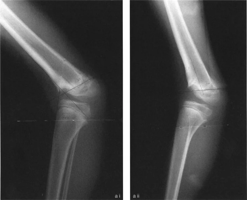 صورة توضح تشوه الركبة الخلفي في عظم الفخذ مع زاوية فخذية خلفية بعيدة غير طبيعية (PDFA = 108°). يظهر المريض انكماشًا في آلية العضلة الرباعية. يقع مركز دوران الزاوية (CORA) عند تقاطع القشرة الأمامية وصفيحة النمو.