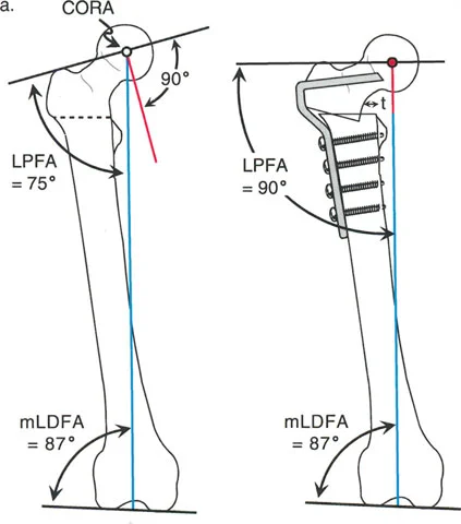 Mastering Deformity Correction: Paley Principles, Osteotomy Rules & Hardware Selection
