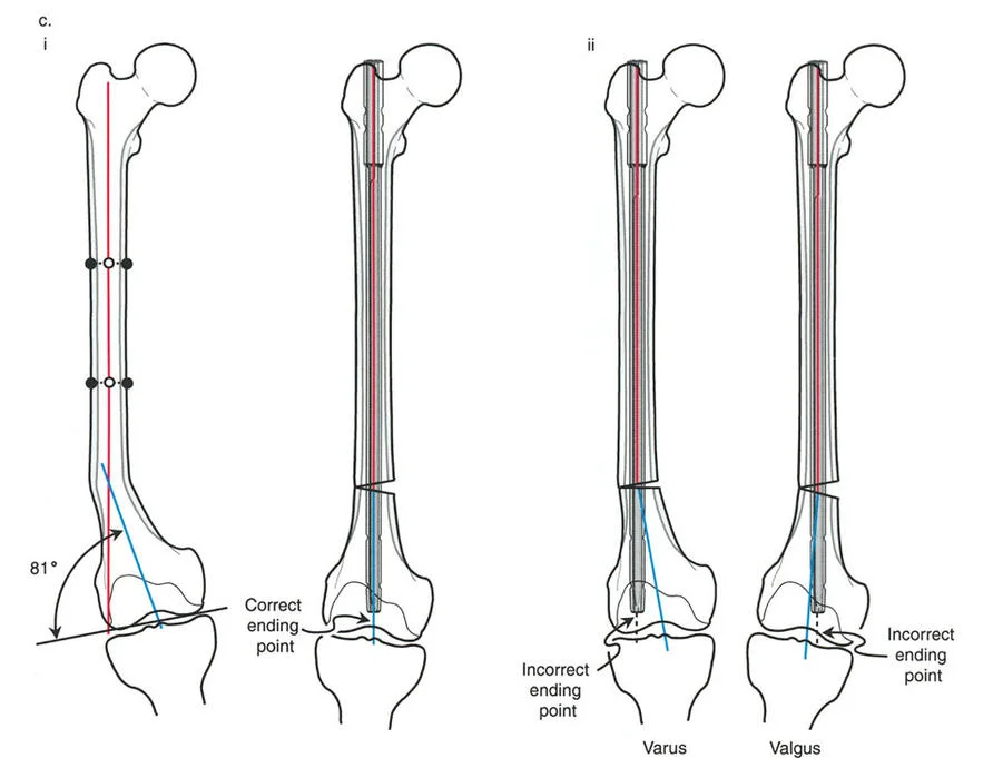 صورة توضيحية لنقاط نهاية المسمار النخاعي في عظم الفخذ وتأثيرها على المحاذاة