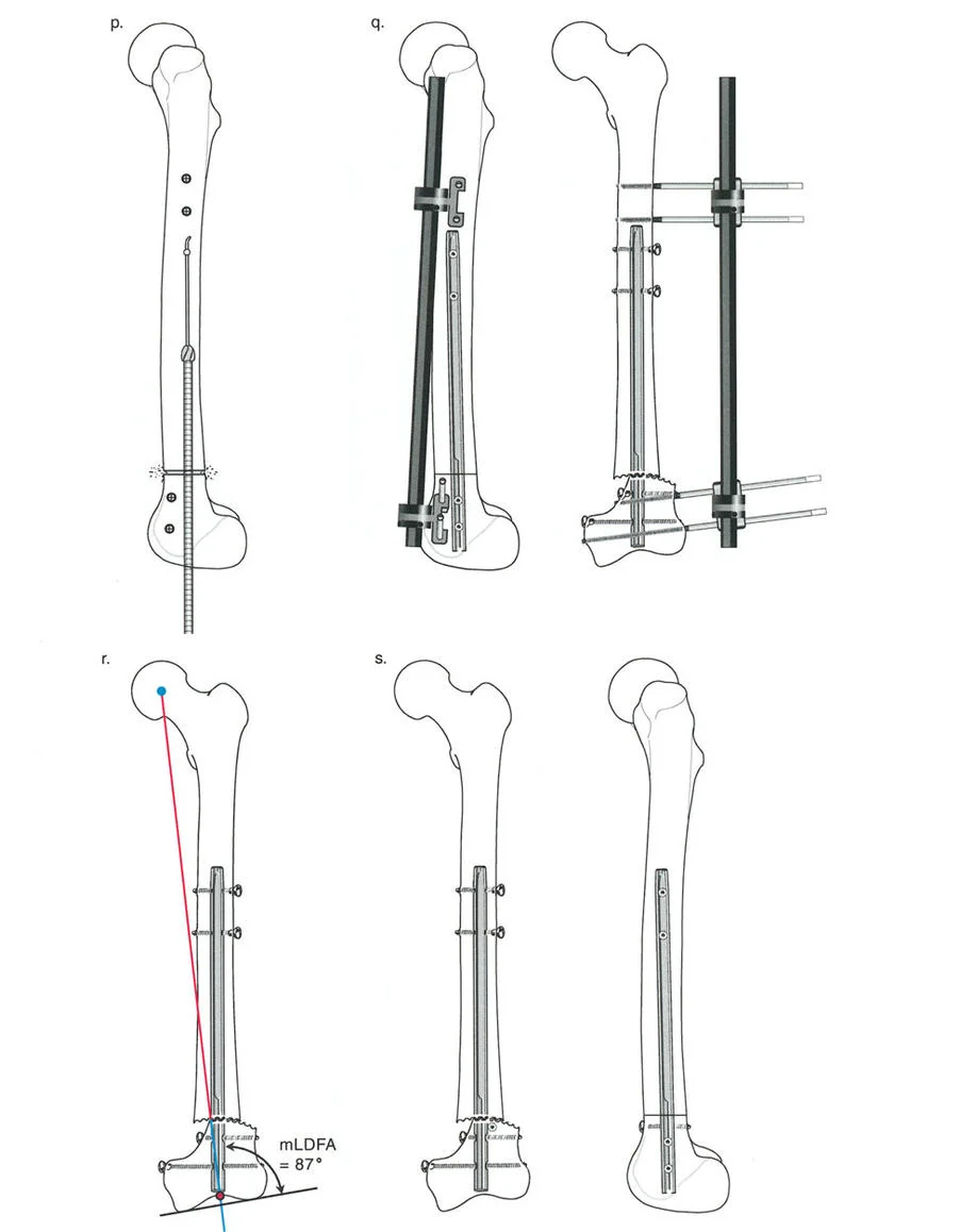 صورة توضيحية لـ تصحيح تشوهات الأطراف السفلية المتقدمة: دليل شامل لتقنيات بالي في اليمن