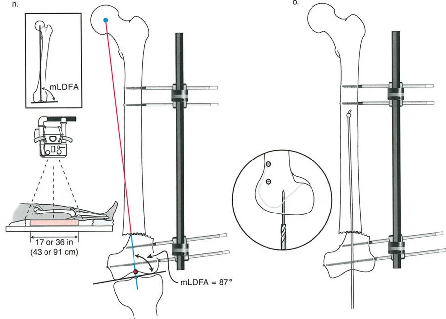 تصحيح تشوهات الأطراف السفلية المتقدمة: دليل شامل لتقنيات بالي في اليمن