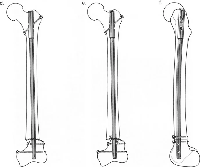 صورة توضيحية لـ تصحيح تشوهات الأطراف السفلية المتقدمة: دليل شامل لتقنيات بالي في اليمن