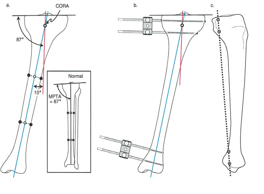 صورة توضيحية لـ تصحيح تشوهات الأطراف السفلية المتقدمة: دليل شامل لتقنيات بالي في اليمن