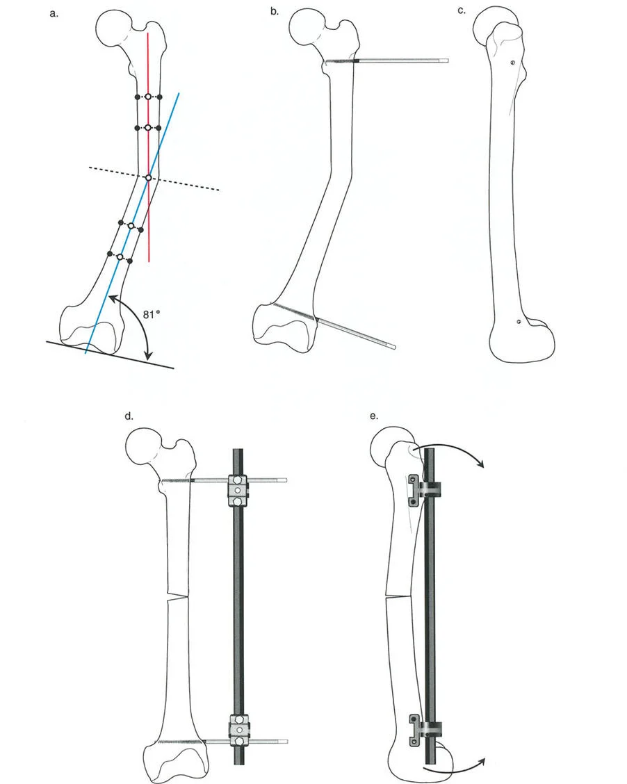 صورة توضح فشل التثبيت أحادي المسمار في السيطرة على التشوه في المستوى السهمي