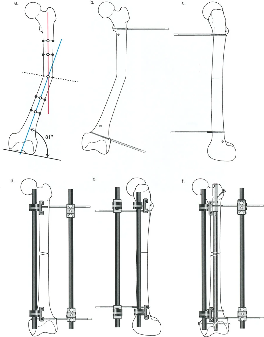 صورة توضيحية لـ تصحيح تشوهات العظام المتقدمة: مبادئ بالي وتقنيات الأستاذ الدكتور محمد هطيف في صنعاء