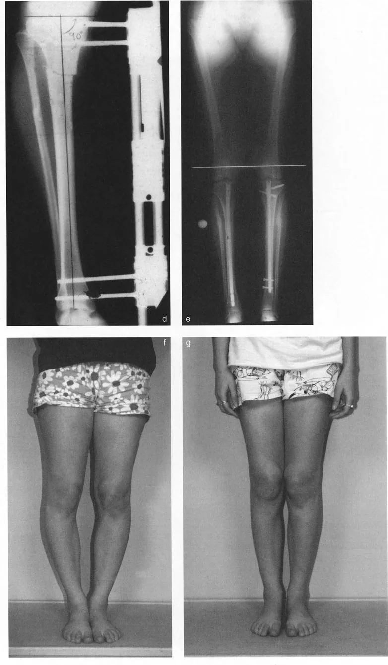 صورة توضح تصحيح تقوس الساقين الشديد باستخدام قطع العظم القُببي البؤري والتثبيت الخارجي