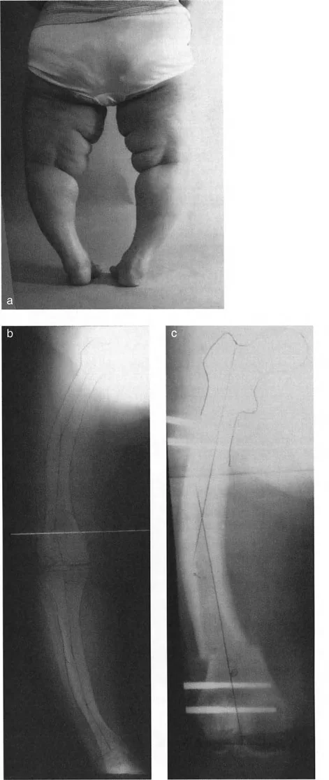توضيح طبي: تثبيت المسمار الداخلي بمساعدة المثبت الخارجي (FAN): الحل المتقدم لتصحيح تشوهات العظام