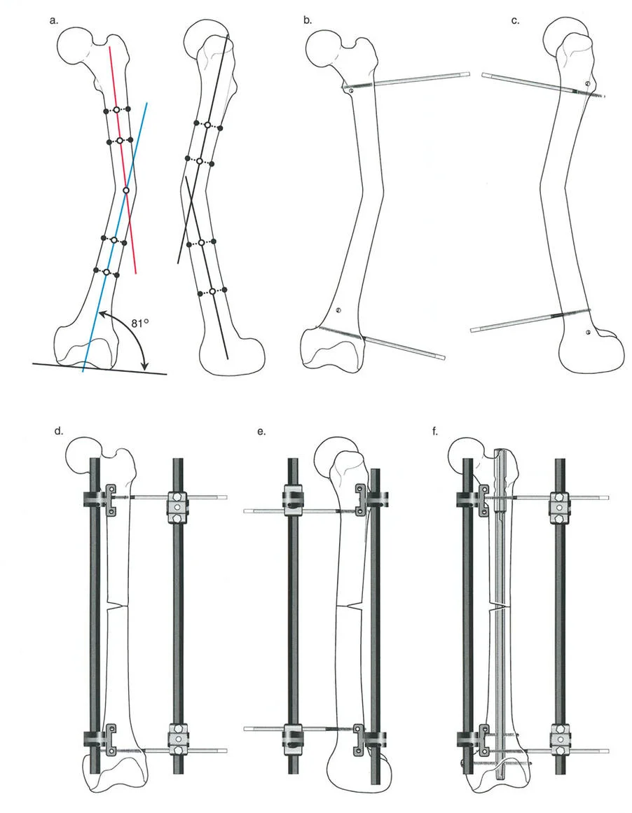 تثبيت المسمار الداخلي بمساعدة المثبت الخارجي (FAN): الحل المتقدم لتصحيح تشوهات العظام