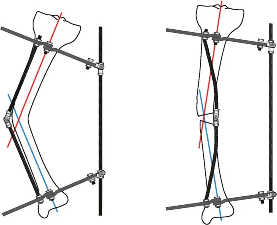 توضيح طبي: تصحيح تشوهات العظام وتطويلها: خبرة الأستاذ الدكتور محمد هطيف في صنعاء