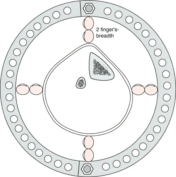 توضيح طبي: تصحيح تشوهات العظام وتطويلها: خبرة الأستاذ الدكتور محمد هطيف في صنعاء