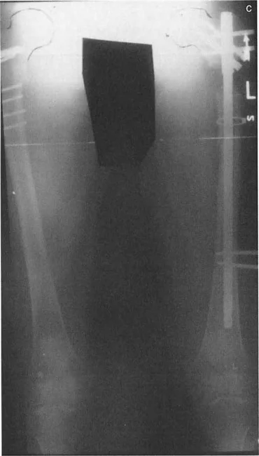 توضيح طبي: تصحيح تشوهات العظام وتطويلها: خبرة الأستاذ الدكتور محمد هطيف في صنعاء