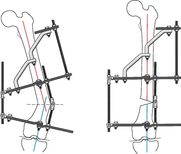توضيح طبي: تصحيح تشوهات العظام وتطويلها: خبرة الأستاذ الدكتور محمد هطيف في صنعاء