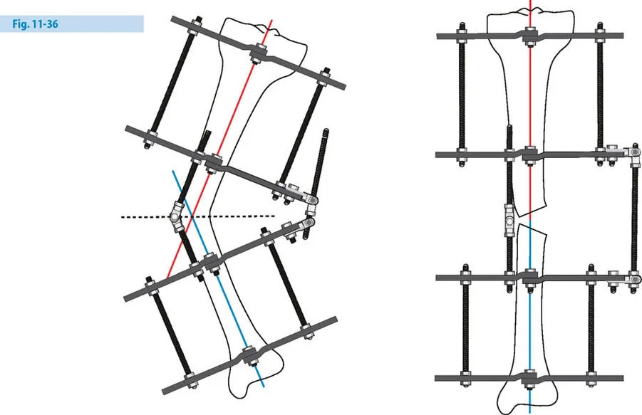 توضيح طبي: تصحيح تشوهات العظام وتطويلها: خبرة الأستاذ الدكتور محمد هطيف في صنعاء