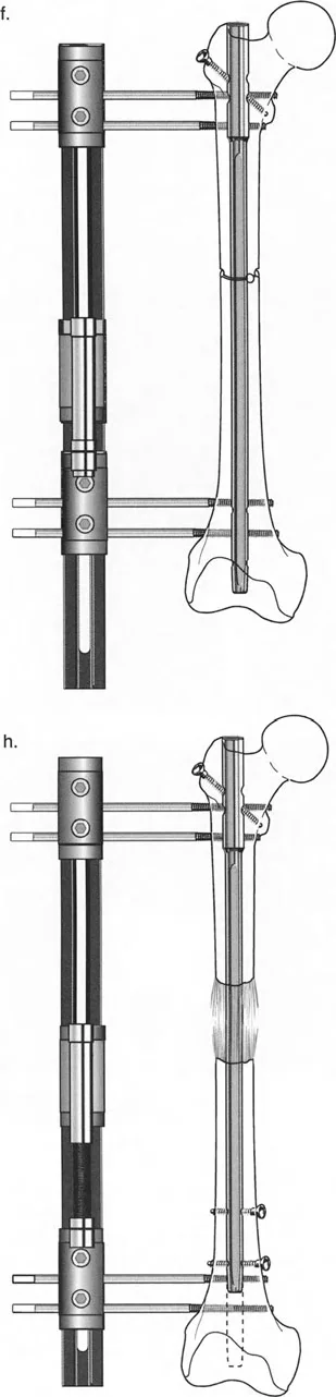 توضيح طبي: تصحيح تشوهات العظام وتطويلها: خبرة الأستاذ الدكتور محمد هطيف في صنعاء