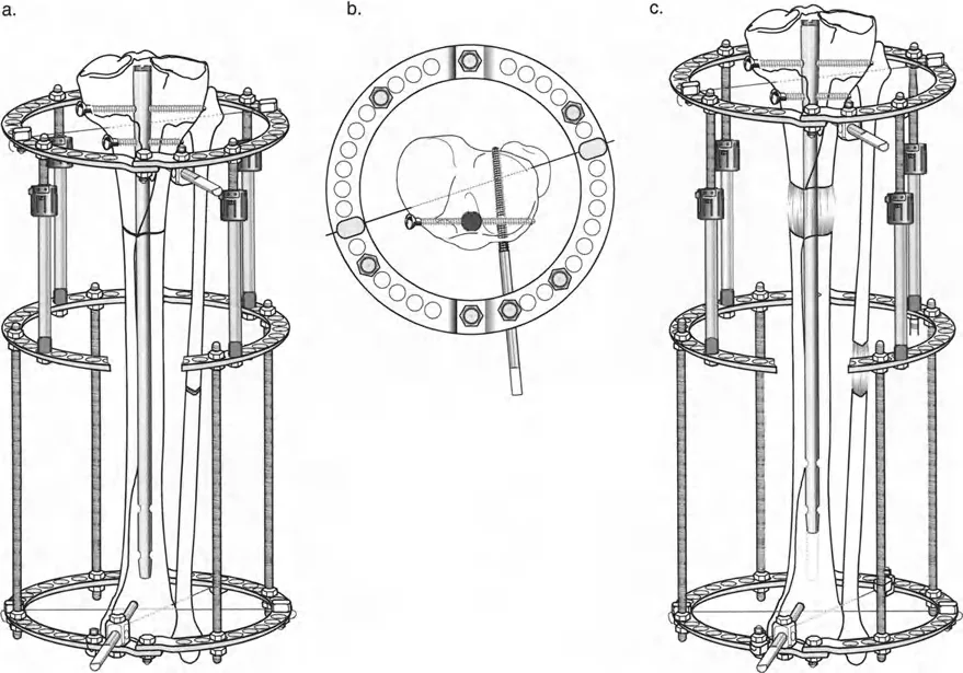 توضيح طبي: تصحيح تشوهات العظام وتطويلها: خبرة الأستاذ الدكتور محمد هطيف في صنعاء