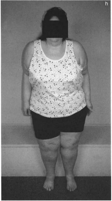 تصحيح تشوهات العظام وتطويلها: خبرة الأستاذ الدكتور محمد هطيف في صنعاء