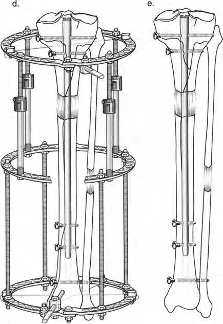 توضيح طبي: تصحيح تشوهات العظام وتطويلها: خبرة الأستاذ الدكتور محمد هطيف في صنعاء