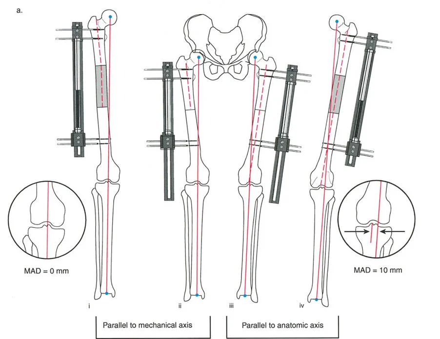 توضيح طبي: تصحيح تشوهات العظام وتطويلها: خبرة الأستاذ الدكتور محمد هطيف في صنعاء
