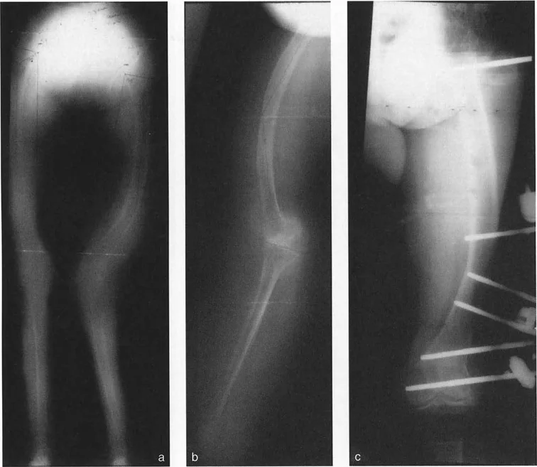 توضيح طبي: تصحيح تشوهات العظام وتطويلها: خبرة الأستاذ الدكتور محمد هطيف في صنعاء