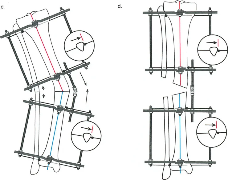 صورة توضيحية لـ إتقان مبادئ بالي: الدليل الشامل لأجهزة التثبيت الخارجية وجراحة العظم لتصحيح تشوهات الأطراف