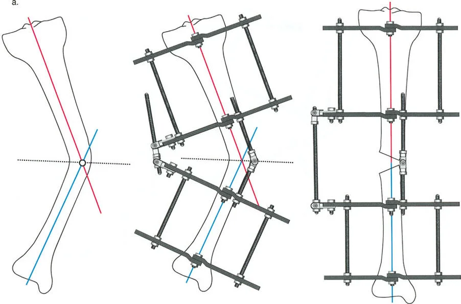 صورة توضيحية لـ إتقان مبادئ بالي: الدليل الشامل لأجهزة التثبيت الخارجية وجراحة العظم لتصحيح تشوهات الأطراف