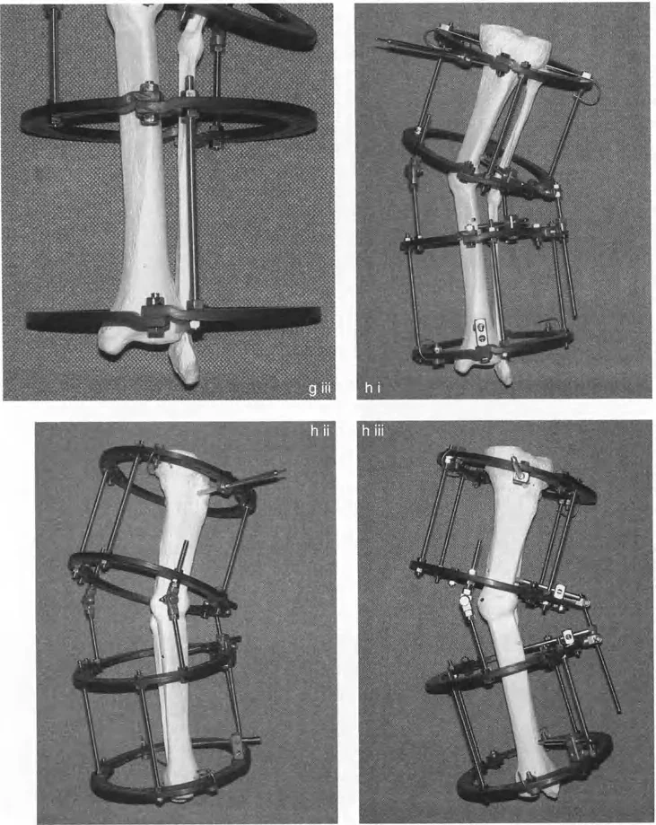 صورة توضيحية لقياس مستوى مركز دوران الانحراف (CORA) على العظم باستخدام المعالم التشريحية.