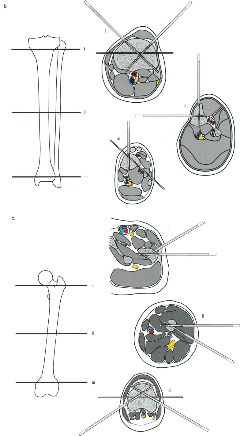 صورة طبية: إتقان مبادئ بالي: الدليل الشامل لأجهزة التثبيت الخارجية وجراحة العظم لتصحيح تشوهات الأطراف