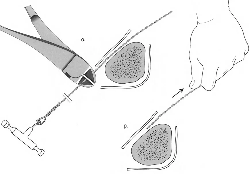 صورة طبية: تصحيح تشوهات العظام بتقنيات بالي المتقدمة الدليل الشامل للمرضى مع الأستاذ الدكتور محمد هطيف