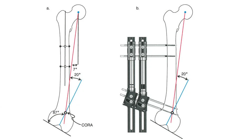 تصحيح تشوهات العظام بتقنيات بالي المتقدمة الدليل الشامل للمرضى مع الأستاذ الدكتور محمد هطيف