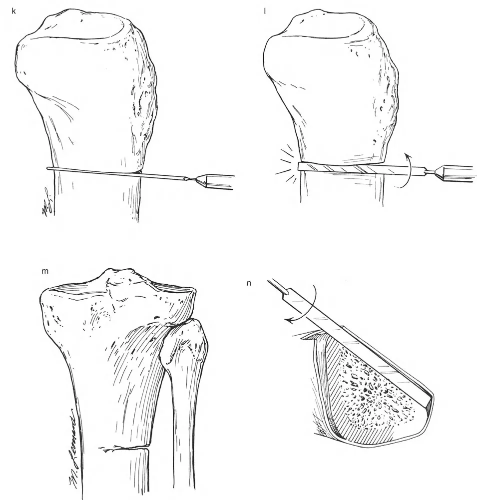 صورة طبية: تصحيح تشوهات العظام بتقنيات بالي المتقدمة الدليل الشامل للمرضى مع الأستاذ الدكتور محمد هطيف