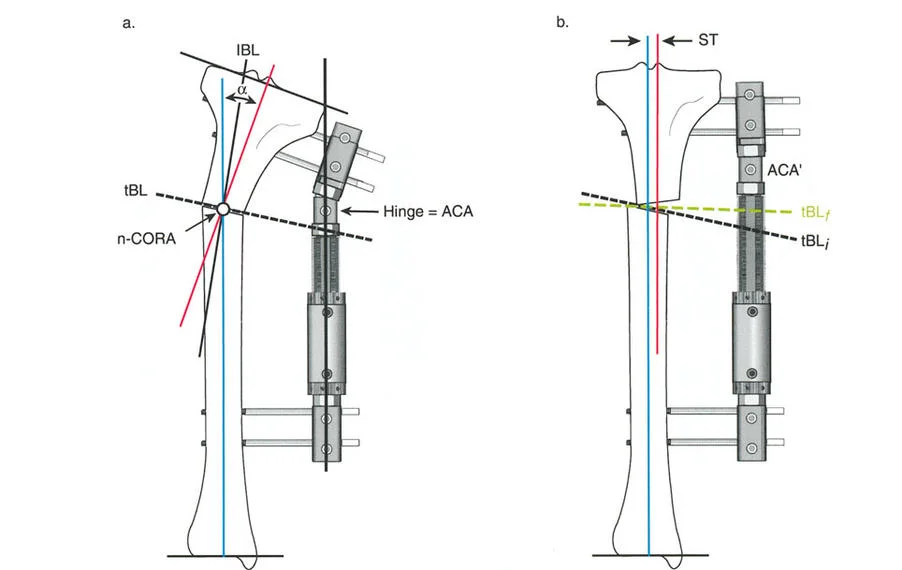 صورة طبية: تصحيح تشوهات العظام بتقنيات بالي المتقدمة الدليل الشامل للمرضى مع الأستاذ الدكتور محمد هطيف