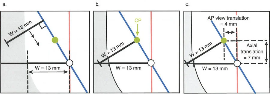 صورة طبية: تصحيح تشوهات العظام بتقنيات بالي المتقدمة الدليل الشامل للمرضى مع الأستاذ الدكتور محمد هطيف