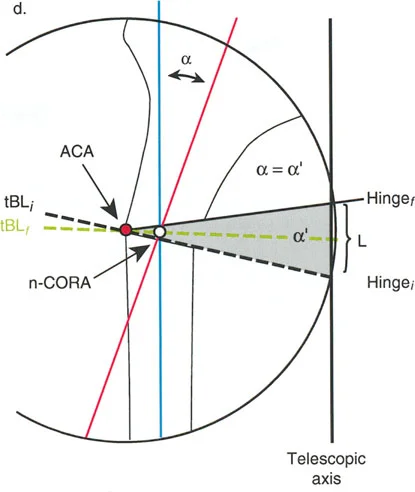 مخطط يوضح قواعد بالي لقطع العظم