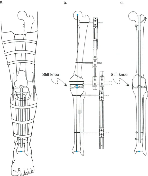 صورة طبية: تصحيح تشوهات العظام بتقنيات بالي المتقدمة الدليل الشامل للمرضى مع الأستاذ الدكتور محمد هطيف